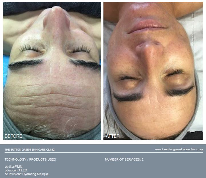 Bio-Therapeutic bt-titan® MN Model AE