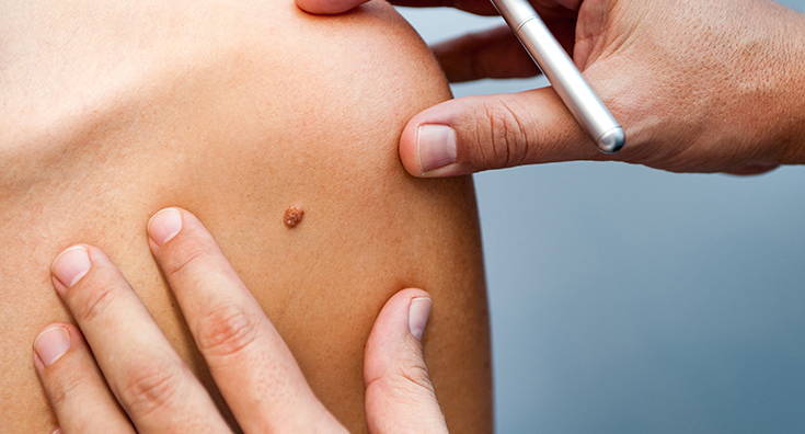 Do You Know the Warning Signs of Skin Cancer?