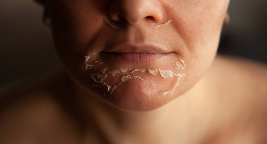 Peel Complications Nobody Talks About (and How to Handle Them)