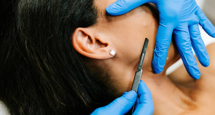 How to Select a Dermaplaning System